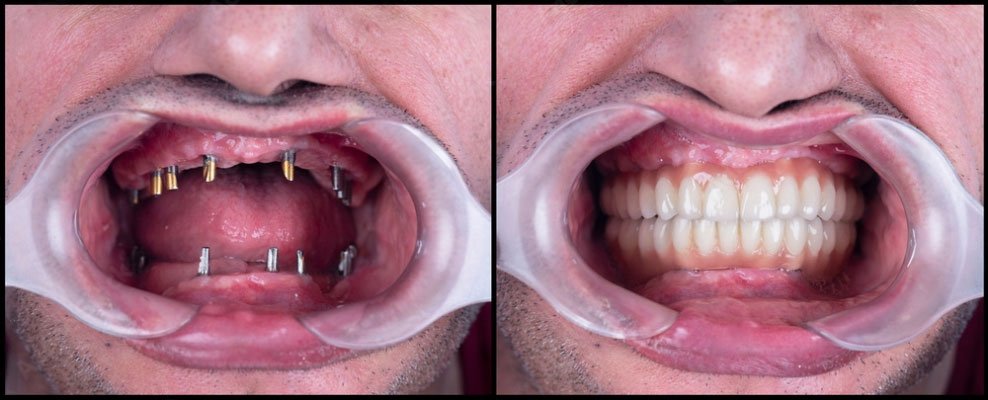 use of dental implant positive side